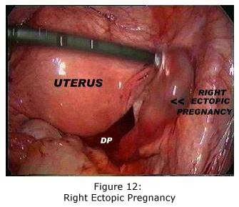 Tubal Ectopic Pregnancy